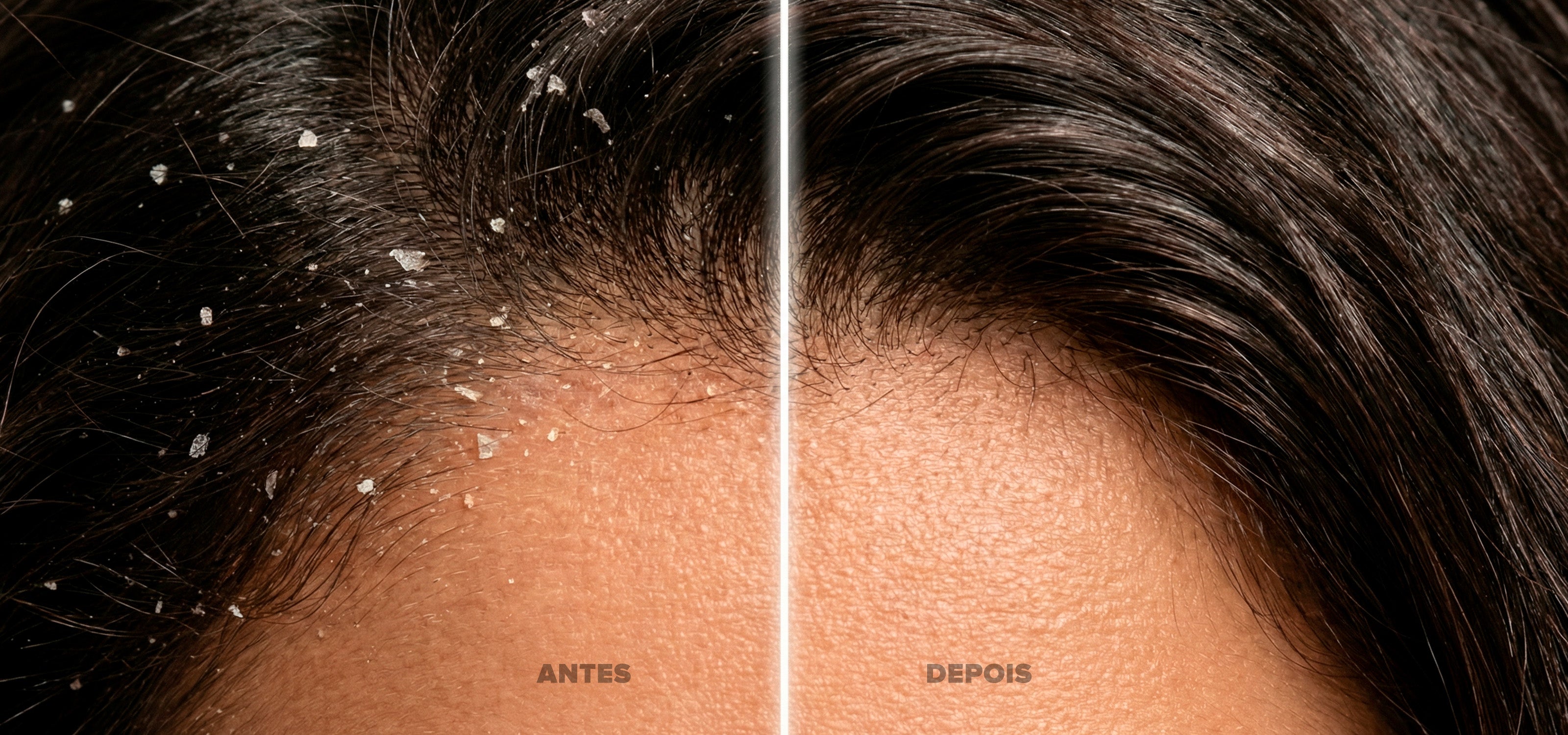 Imagem dividida ao meio, de uma pessoa morena. De um lado, um cabelo com caspa - antes de usar o Scalp Relief - e do outro lado, um cabelo limpo e sem caspa - após usar o Scalp Relief.