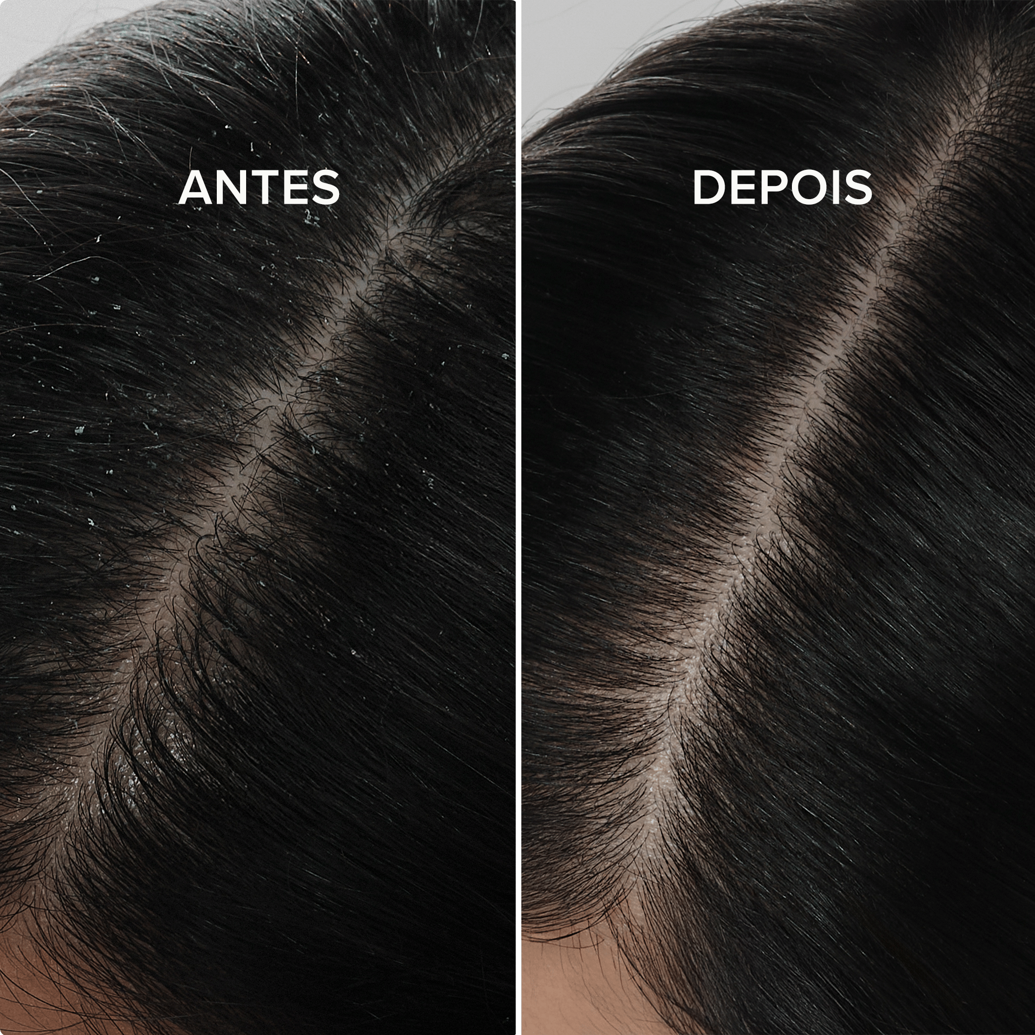 Mulher morena com o cabelo antes e depois do uso da Linha Anticaspa Scalp Relief. Antes o cabelo estava com caspas visíveis e, depois do uso, o cabelo está limpo e sedoso.