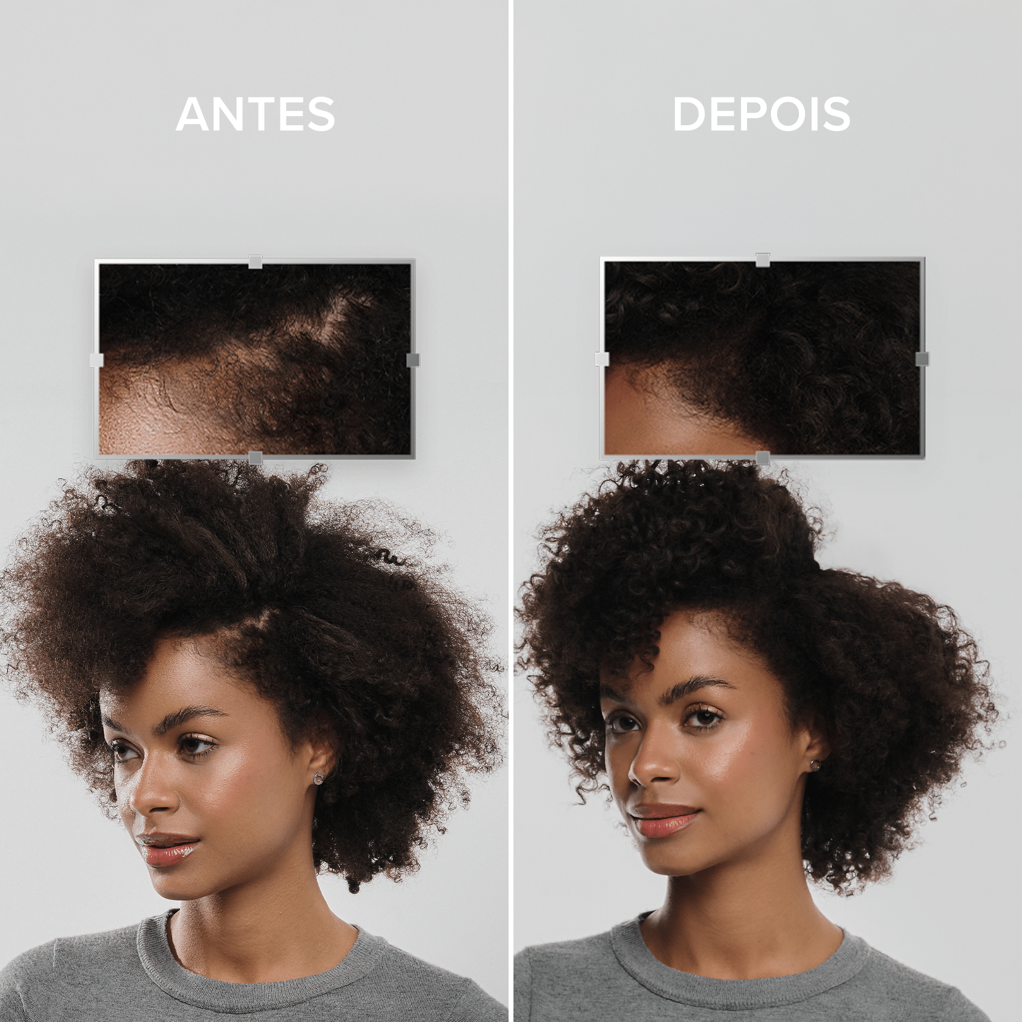 Mulher morena mostrando como seu cabelo era antes e depois de usar os produtos da LinhaAntiqueda UltraResistance. Antes era um cabelo com várias falhas e falta de cabelo. Depois do uso, o cabelo está mais encorpado e preenchido.