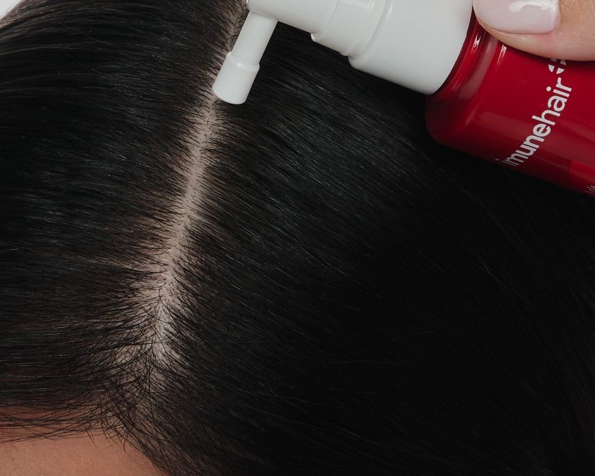 Queda de cabelo: causas, tratamentos, quando se preocupar e como se prevenir - Imunehair